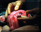 Samuel's Fetal Surgery